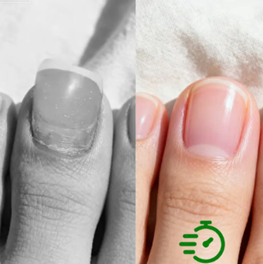 Last Day Of Discount 🔥 Nail Repair & Antifungal Solution